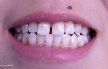 牙齿裂缝的预防方法